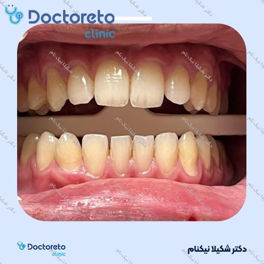 بلیچینگ دندان (سفید کردن دندان)