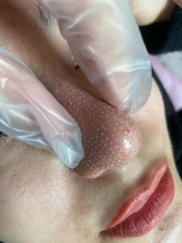 عمل زیبایی بینی (رینوپلاستی)