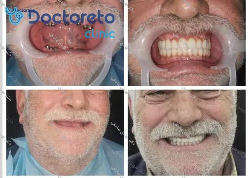 ایمپلنت دندان بدون روکش (هر واحد)