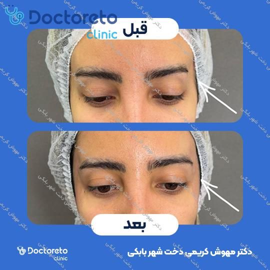 تزریق ژل شقیقه