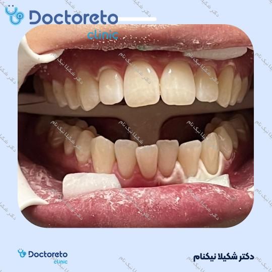 بلیچینگ دندان (سفید کردن دندان)