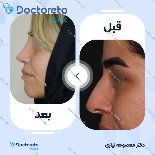 عمل جراحی زیبایی بینی استخوانی (رینوپلاستی)