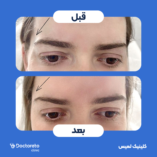 تزریق ژل شقیقه