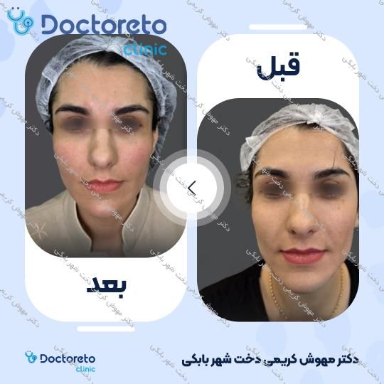 تزریق ژل زاویه فک