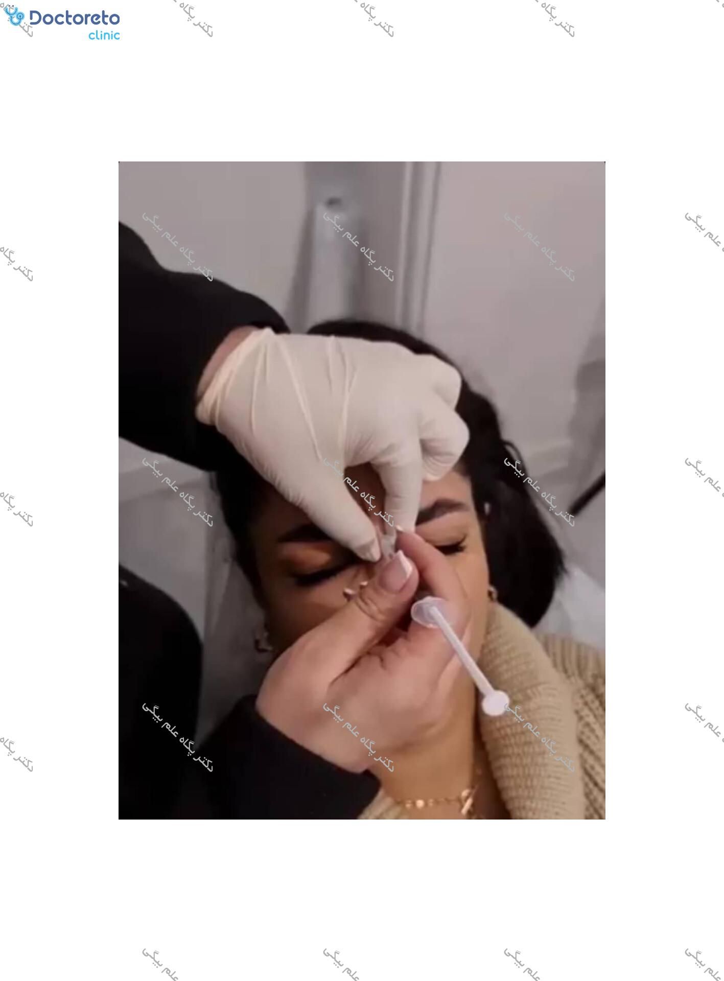 تزریق بوتاکس صورت (پیشانی، خط اخم، پنجه کلاغی)💉