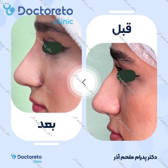 تزریق ژل بینی