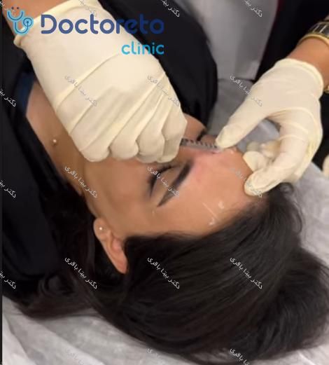 تزریق بوتاکس صورت (پیشانی، خط اخم، پنجه کلاغی)