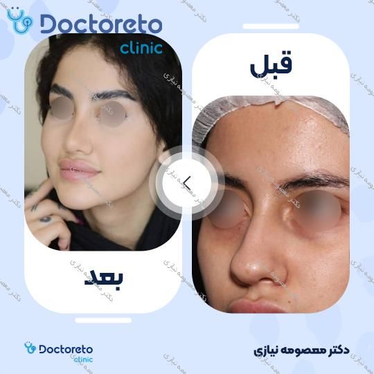 عمل زیبایی بینی (رینوپلاستی)