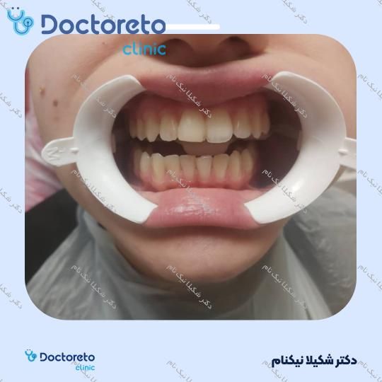 بلیچینگ دندان (سفید کردن دندان)