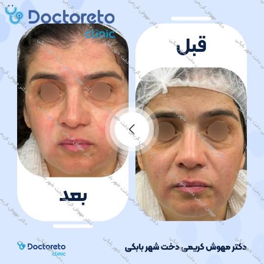 تزریق ژل خط خنده