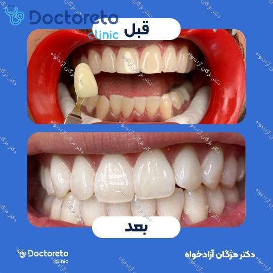 بلیچینگ دندان (سفید کردن دندان)