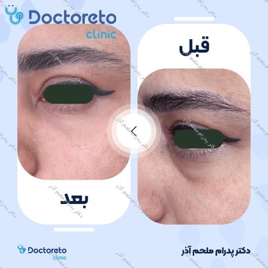 تزریق ژل زیرچشم
