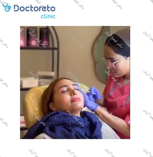 تزریق بوتاکس صورت (پیشانی، خط اخم، پنجه کلاغی)💉