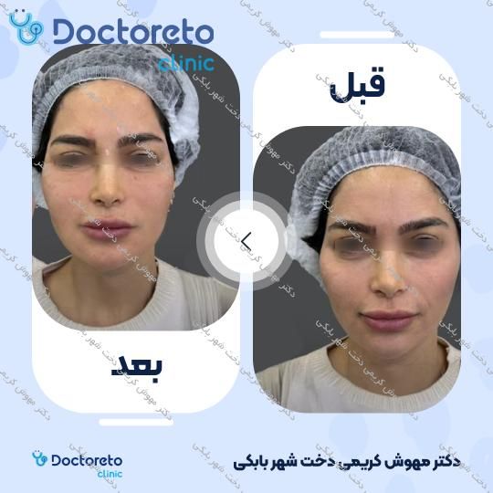 تزریق ژل خط خنده