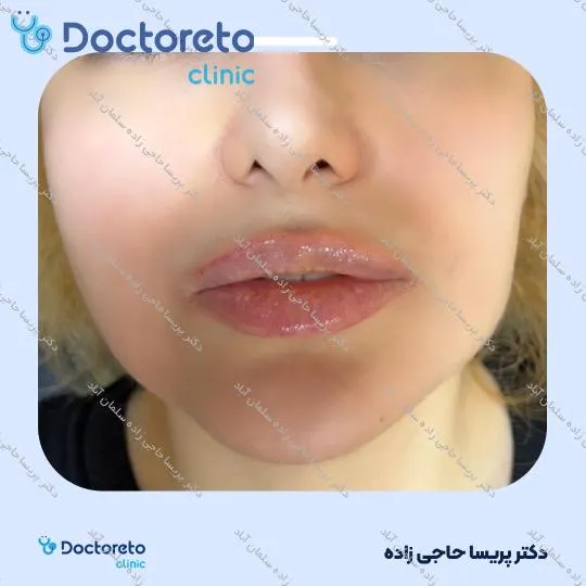 تزریق ژل لب