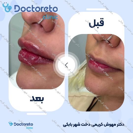 تزریق ژل لب