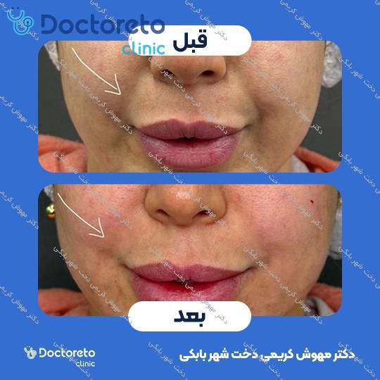 تزریق ژل خط خنده