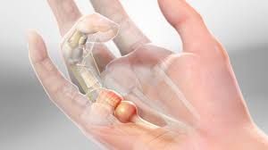 جراحی درمان انگشت ماشه ای