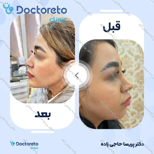 تزریق ژل زاویه فک