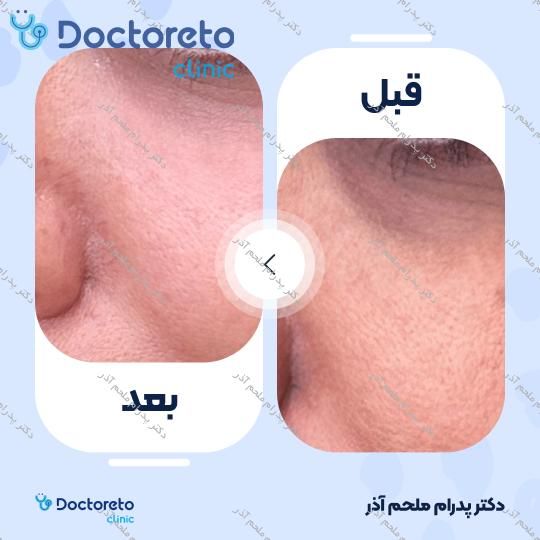 تزریق ژل زیرچشم