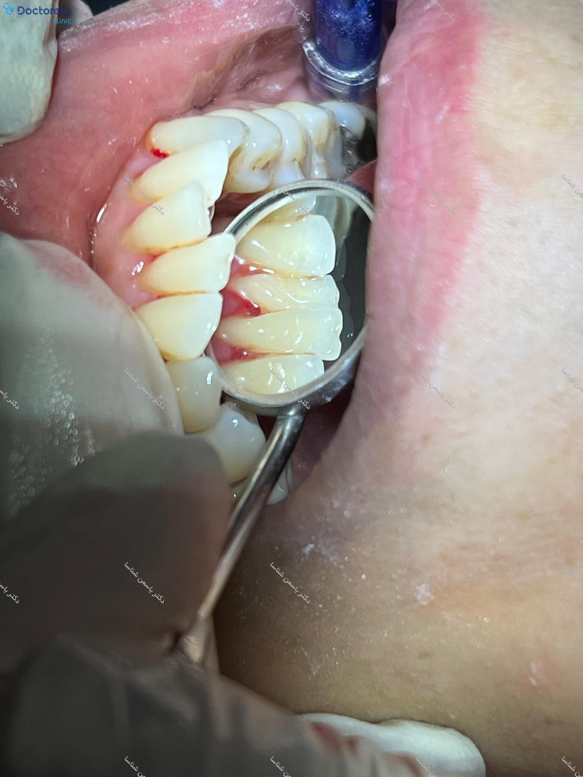 جرم گیری کامل دندان‌های دو فک با بروساژ🦷