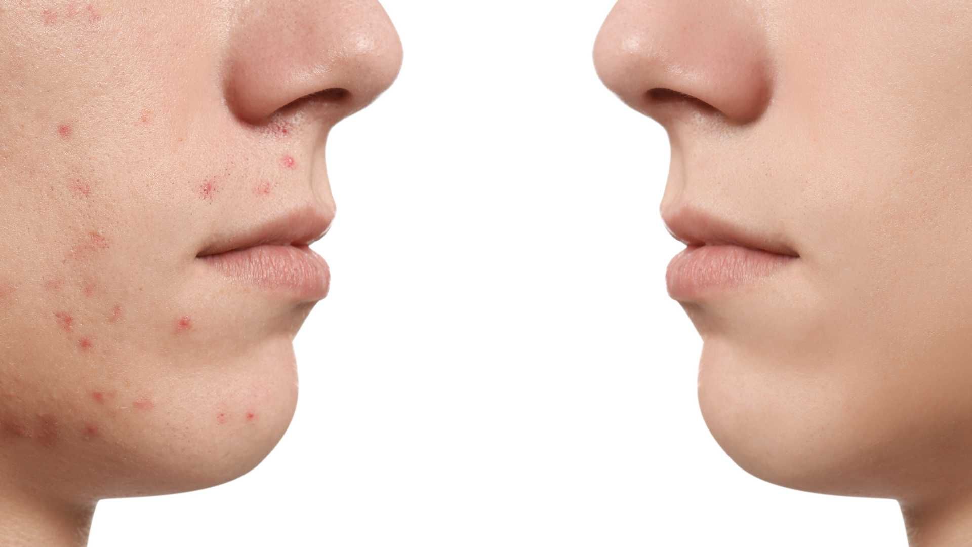 جوانسازی و رفع لک و جای جوش با تزریق مزوتراپی (هر جلسه)