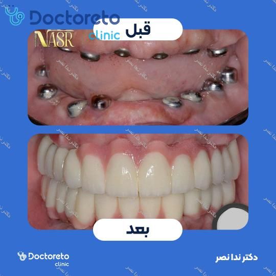 ایمپلنت دندان با روکش (هر واحد)