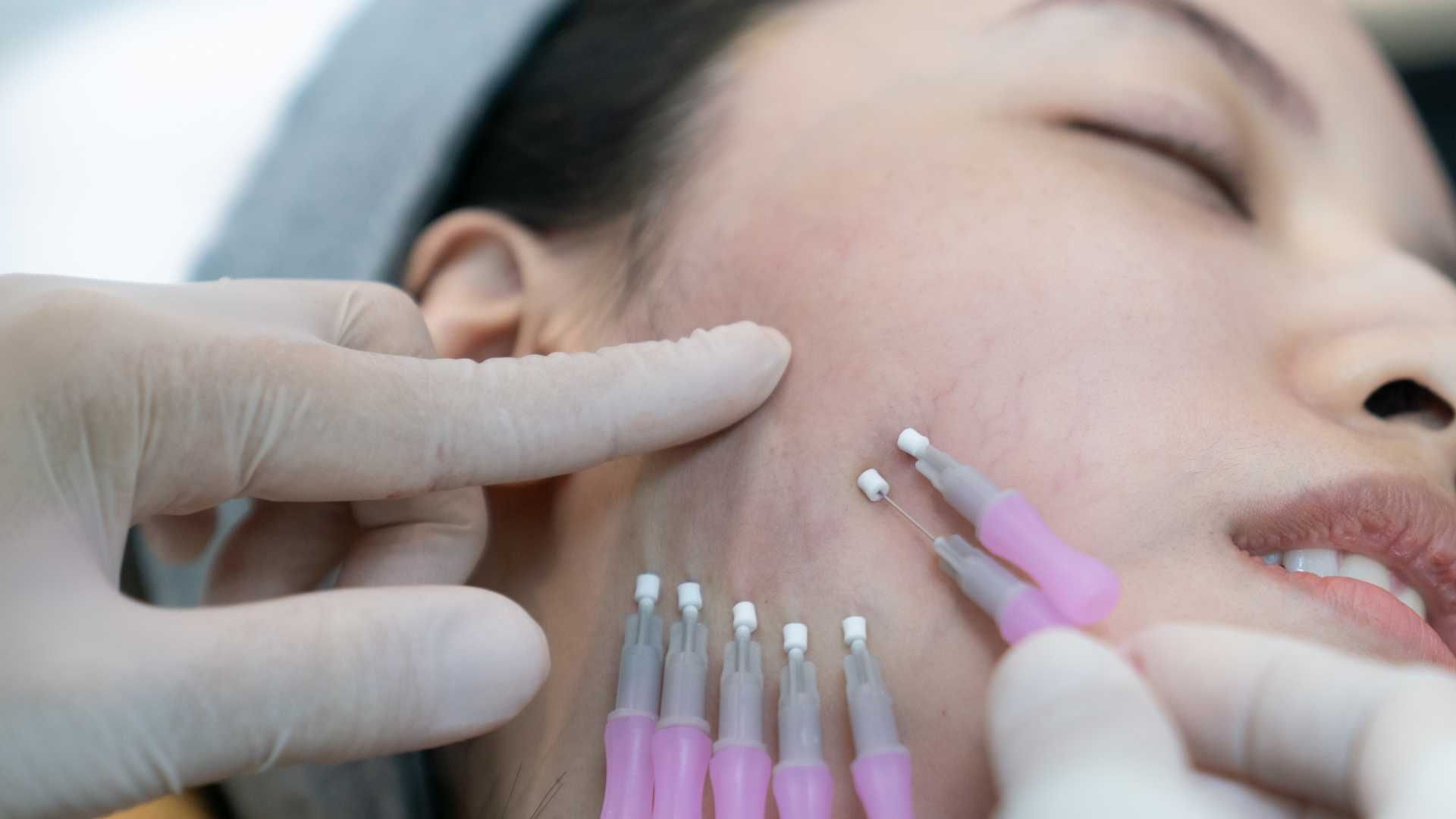 لیفت با نخ صورت