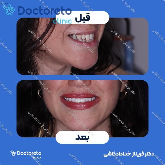 ونیر کامپوریت (هر واحد)