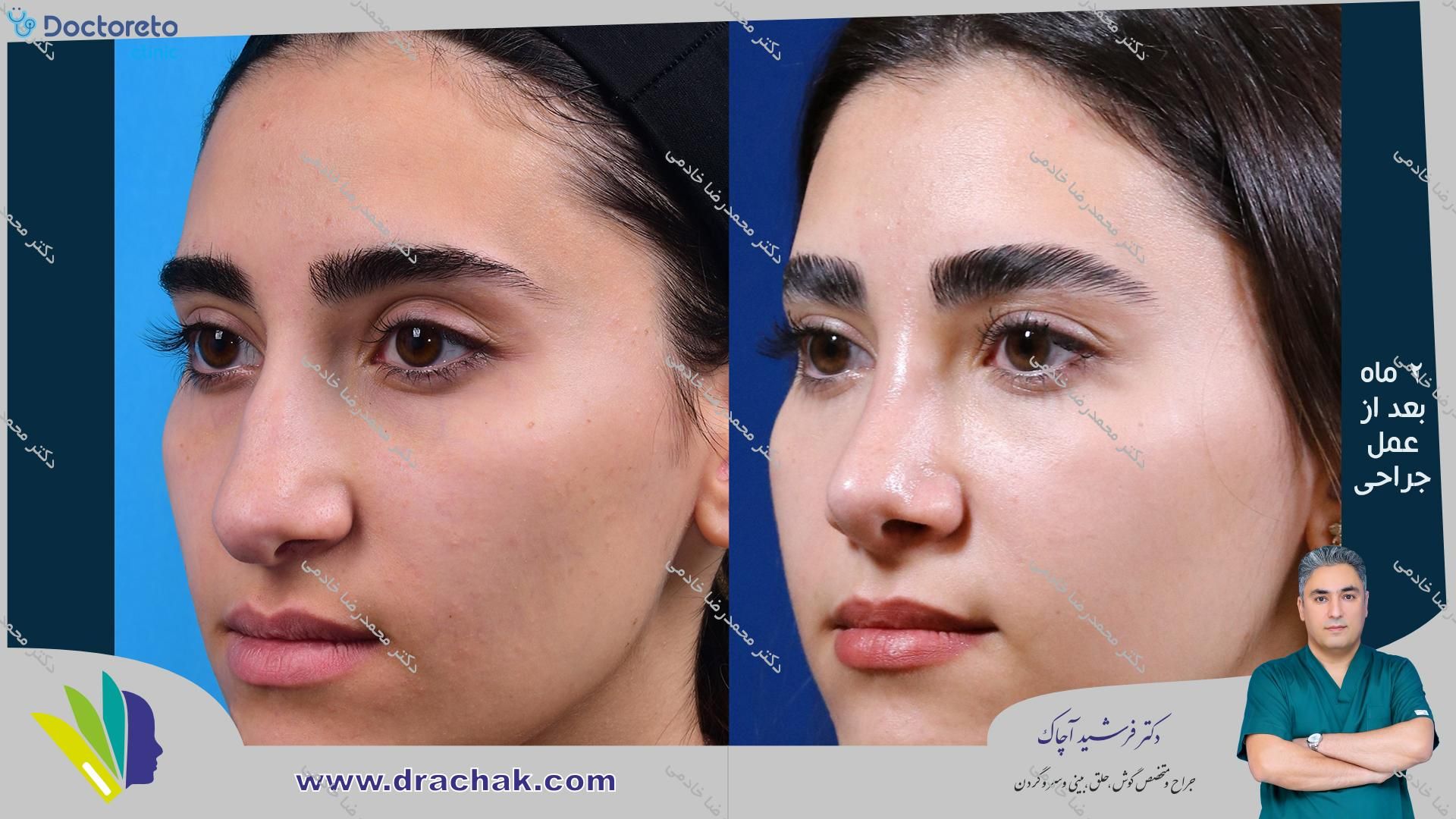 لیزر موهای زائد بانوان با دستگاه کندلا