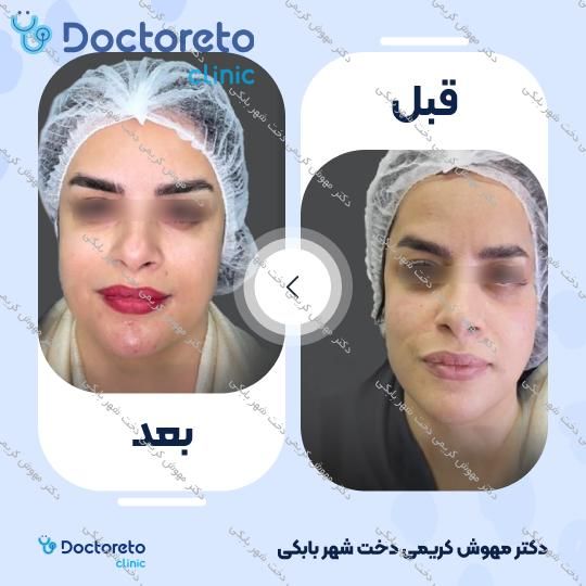 تزریق ژل خط خنده