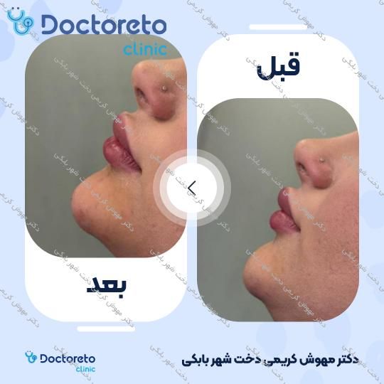 تزریق ژل چانه