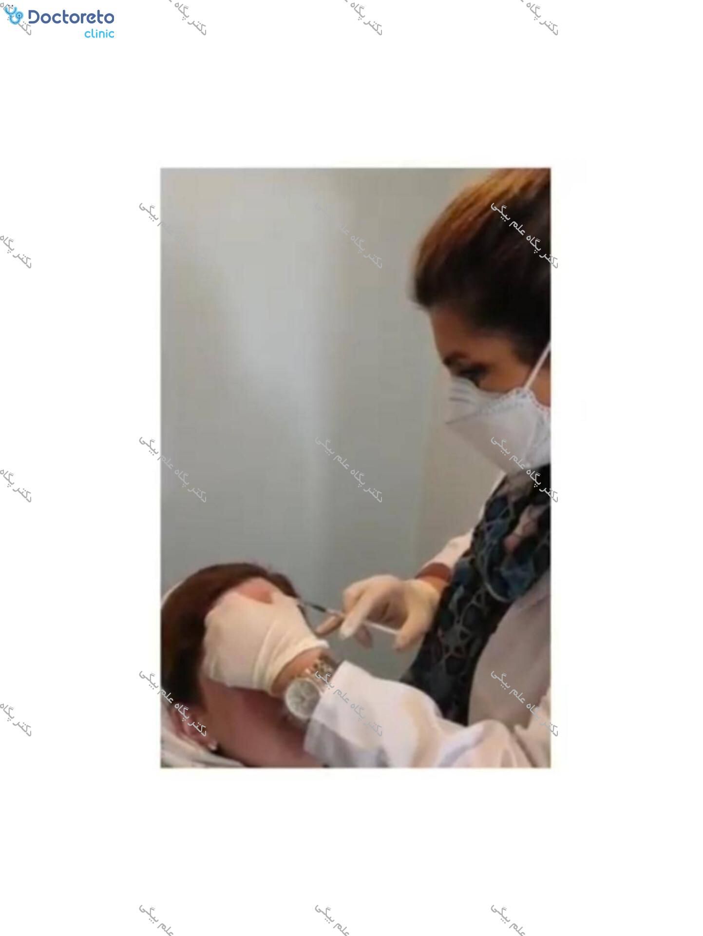 تزریق بوتاکس صورت (پیشانی، خط اخم، پنجه کلاغی)💉