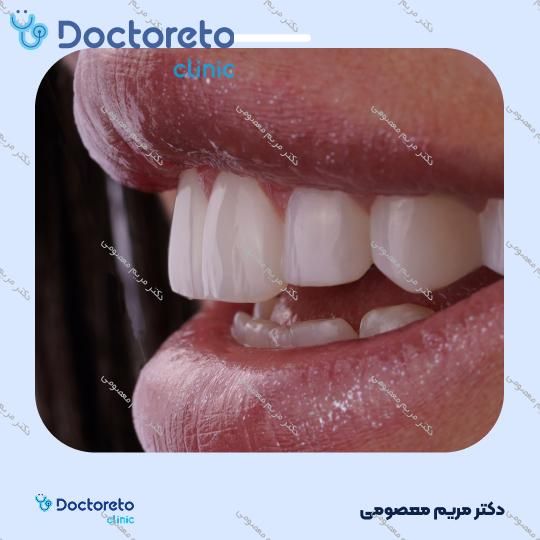 لمینت دندان (هر واحد)