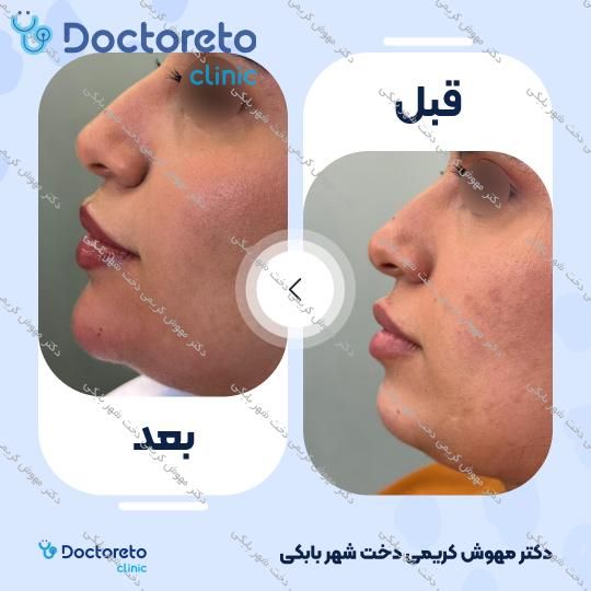 تزریق ژل چانه