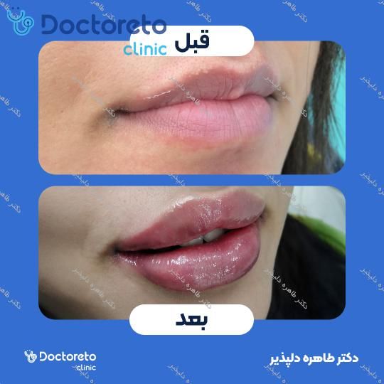 تزریق ژل لب