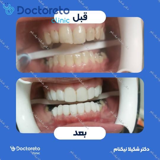 ونیر کامپوزیت (هر واحد)