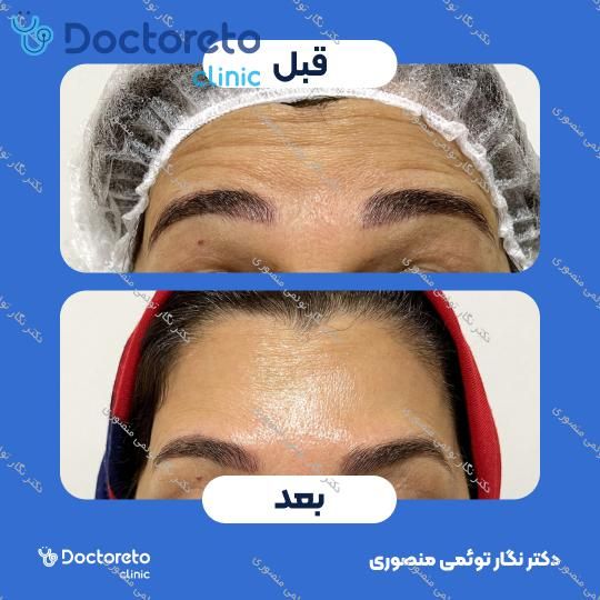 تزریق بوتاکس صورت (پیشانی، خط اخم، پنجه کلاغی)💉