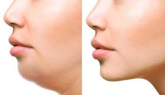 رفع غبغب با تزریق مزوتراپی با برند MCQ و فیوژن (هر جلسه)