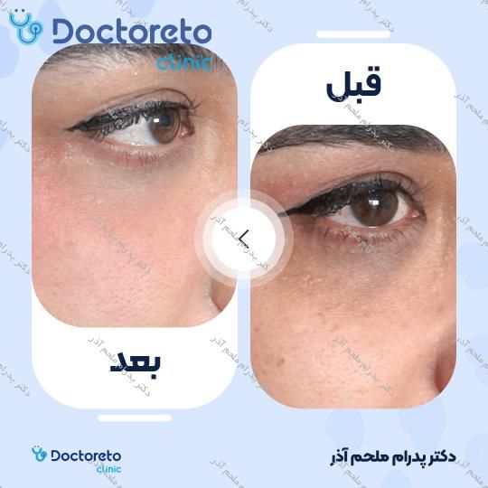 تزریق ژل زیرچشم