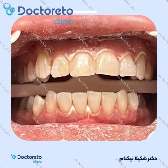 بلیچینگ دندان (سفید کردن دندان)