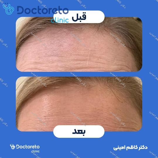 تزریق بوتاکس صورت (پیشانی، خط اخم، پنجه کلاغی)💉