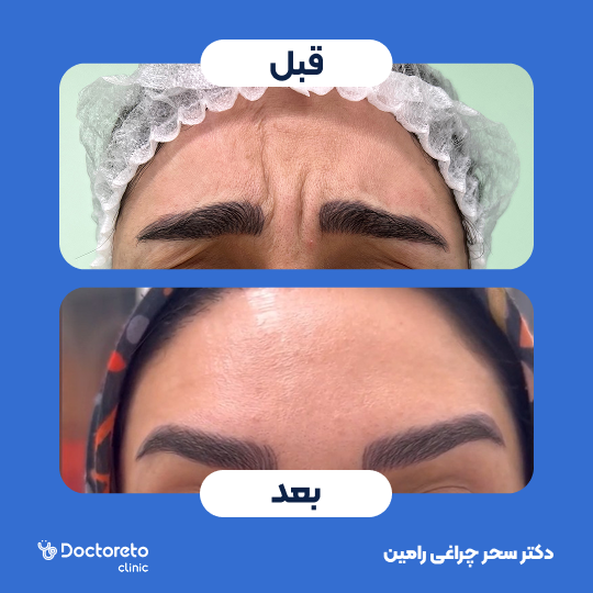 تزریق بوتاکس صورت (پیشانی، خط اخم، پنجه کلاغی)