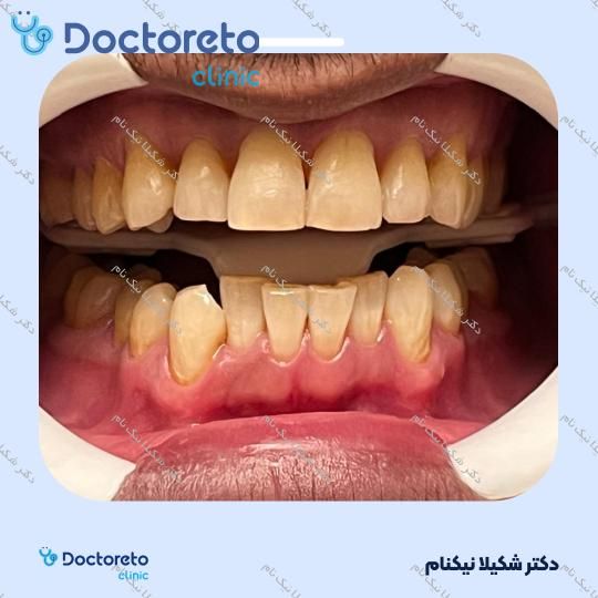 بلیچینگ دندان (سفید کردن دندان)