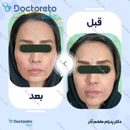 تزریق ژل زاویه فک