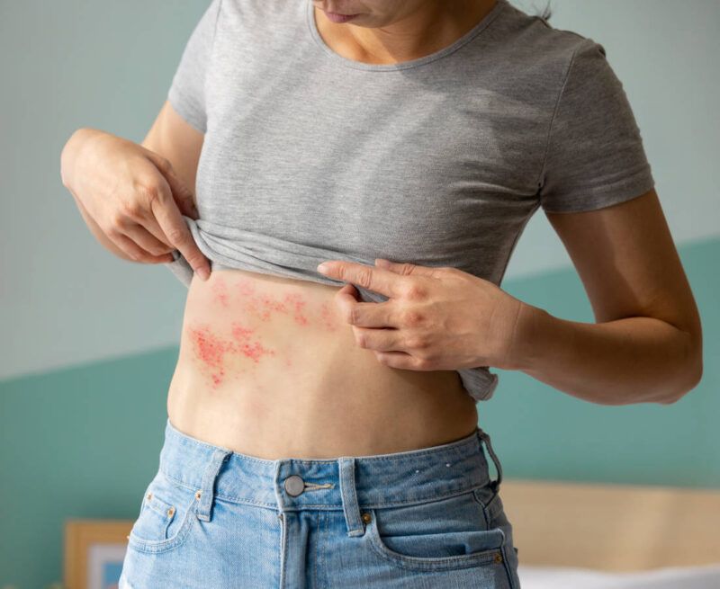 درمان زونا به روش ترمیم و بلوک عصبی