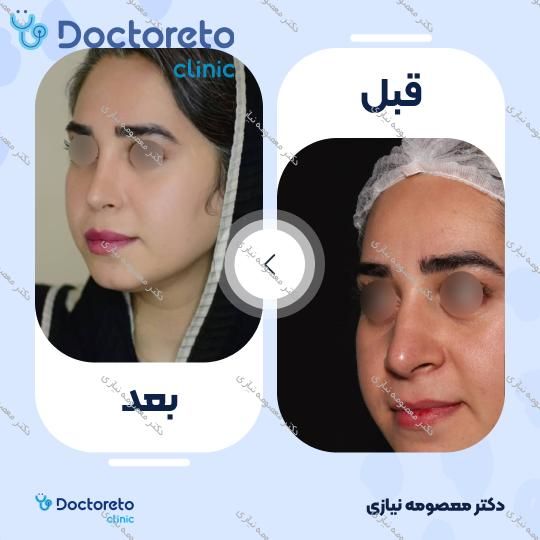 عمل جراحی زیبایی بینی استخوانی (رینوپلاستی)