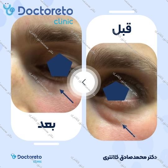 تزریق ژل زیر چشم