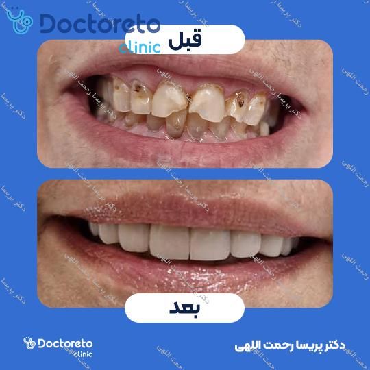 ونیر کامپوزیت (هر واحد)