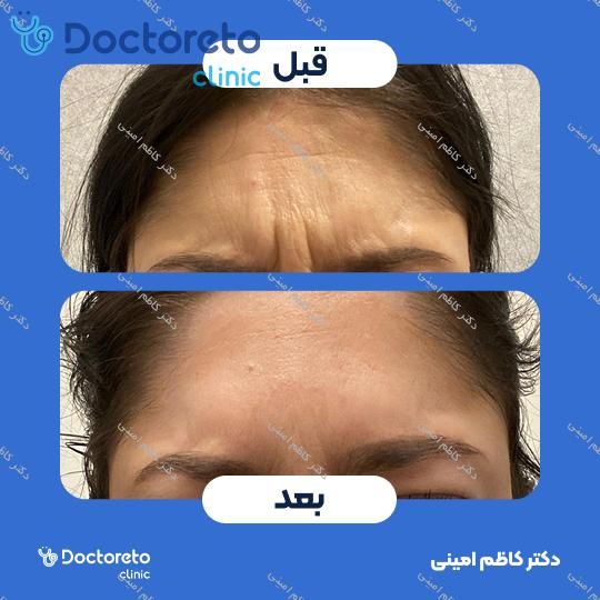 تزریق بوتاکس صورت (پیشانی، خط اخم، پنجه کلاغی)💉